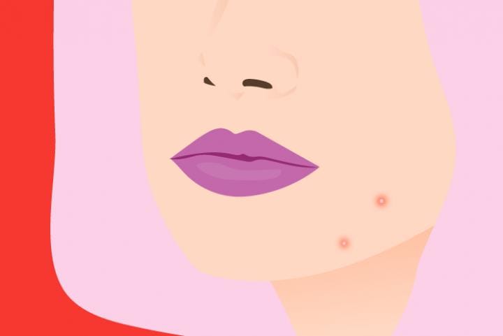 5 Ciri Ini Jadi Tanda Hormonmu Nggak Seimbang