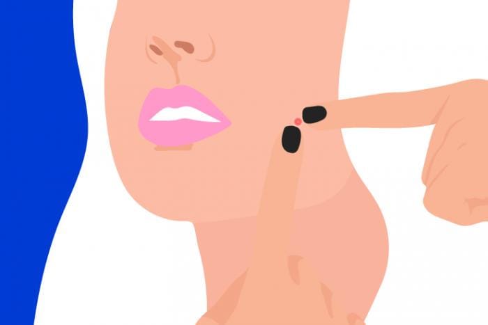 5 Tips Hilangkan Bekas Jerawat yang Mengganggu