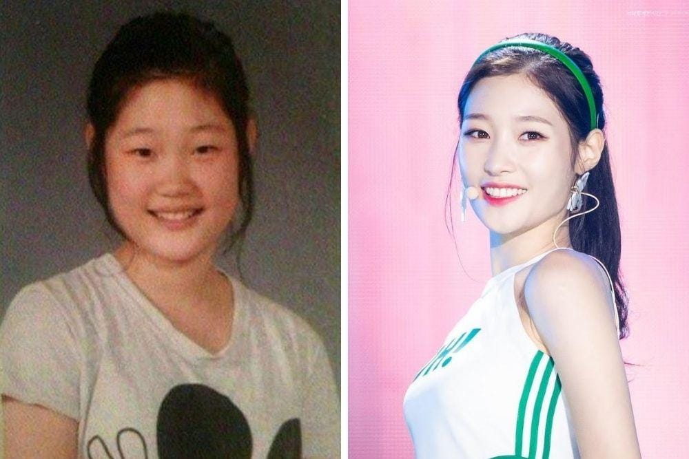 7 Seleb Korea yang Blak-blakan Lakukan Operasi Hidung