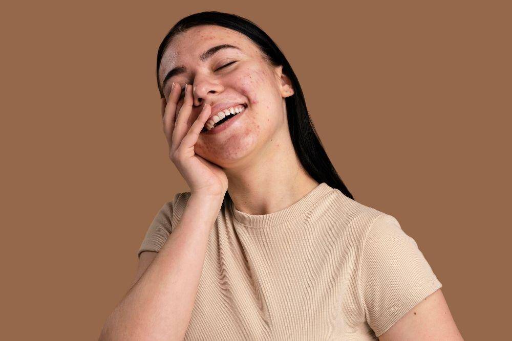Urutan Skincare untuk Kulit Berjerawat/ Freepik.com