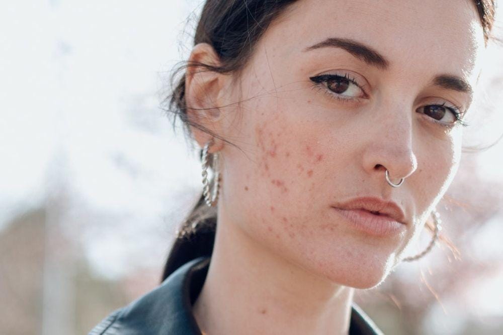 Macam-macam Diet untuk Berbagai Jenis Kulit/ self.com