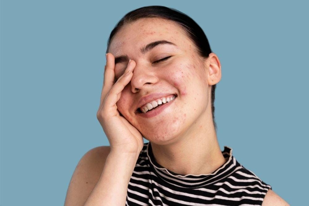 Bahaya Sering Memencet Jerawat, freepik.com