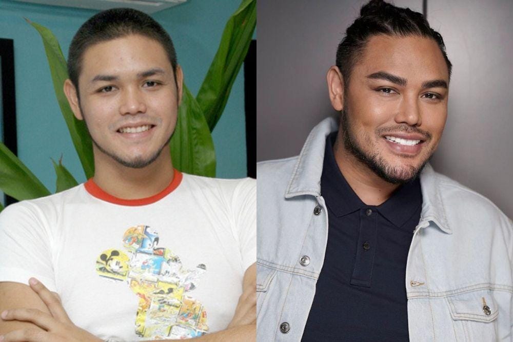 Begini Perbedaan Artis Cowok Sebelum vs Sesudah Veneer Gigi
