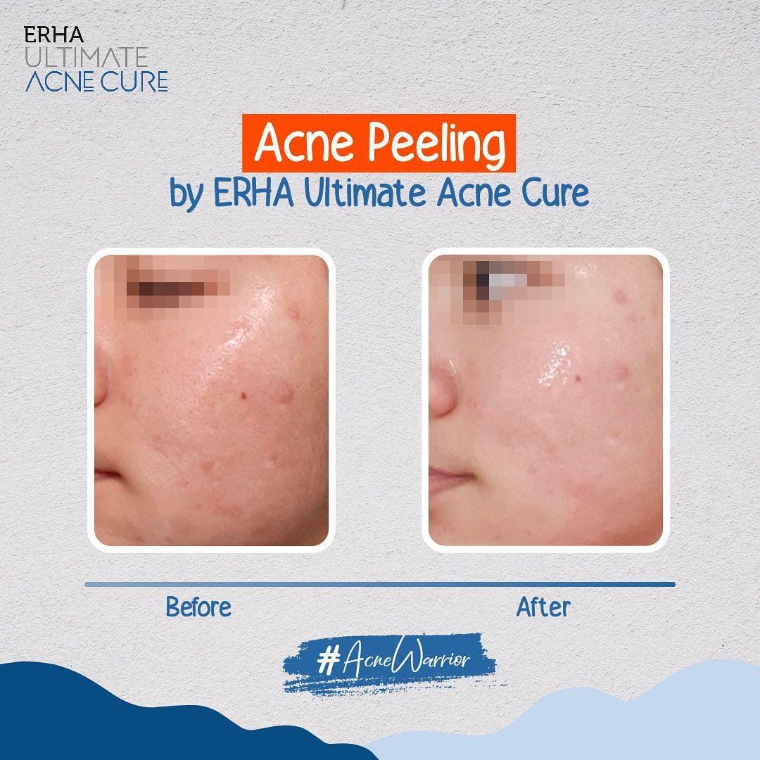 instagram.com/erha_ultimateacnecure
