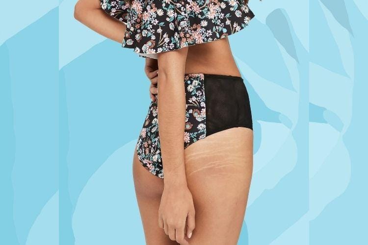 Cara Mengatasi Stretch Marks yang Bikin Nggak Pede